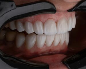 Read more about the article Costo di una Corona Dentale a Gioia Tauro: Cosa Considerare