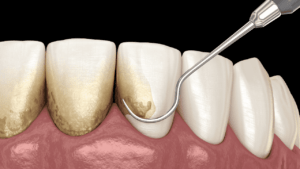 Read more about the article Come si Cura la Parodontite Avanzata: Trattamenti Efficaci per Salvare i Denti