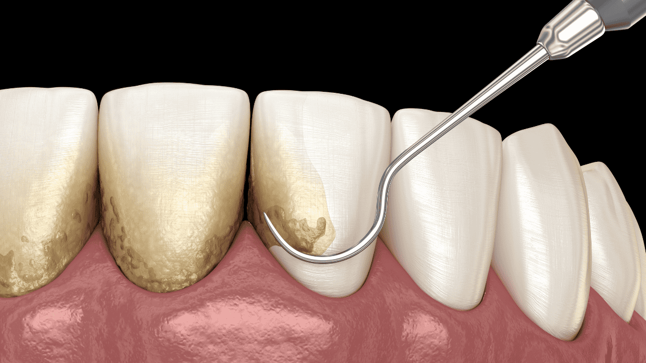 You are currently viewing Come si Cura la Parodontite Avanzata: Trattamenti Efficaci per Salvare i Denti