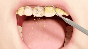 Quanto Dura la Pulizia dei Denti